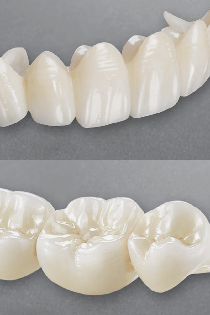 Close-up image of high-quality zirconia dental crowns and bridges showing the natural tooth-like appearance and precision craftsmanship • KOREA NEW N DENTAL CLINIC