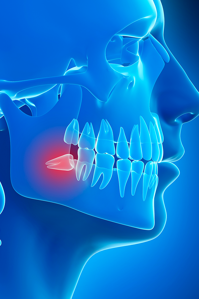 Medical illustration of an impacted wisdom tooth causing pain in the lower jaw. • KOREA NEW N DENTAL CLINIC