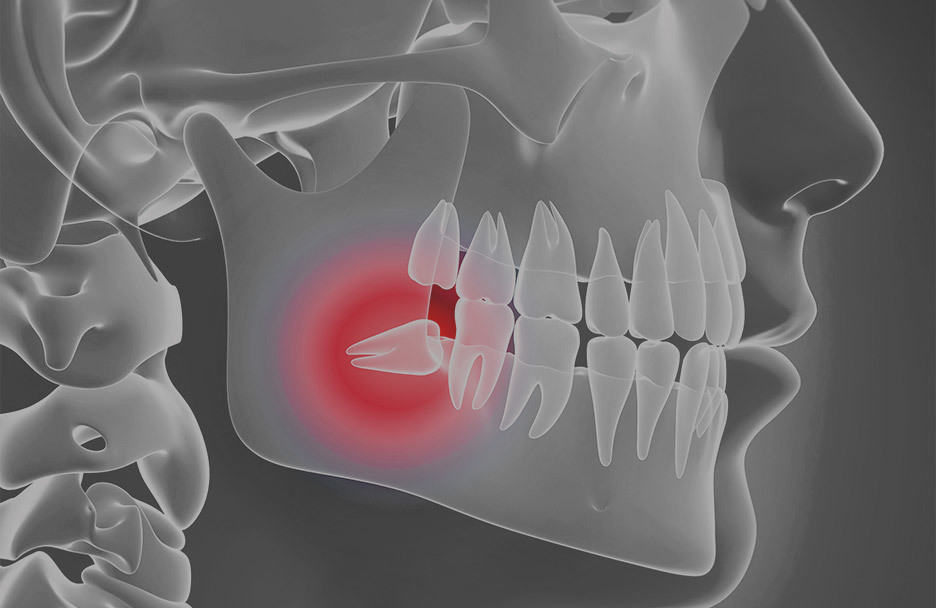 3D illustration of a human jaw with a highlighted impacted wisdom tooth causing pain • KOREA NEW N DENTAL CLINIC