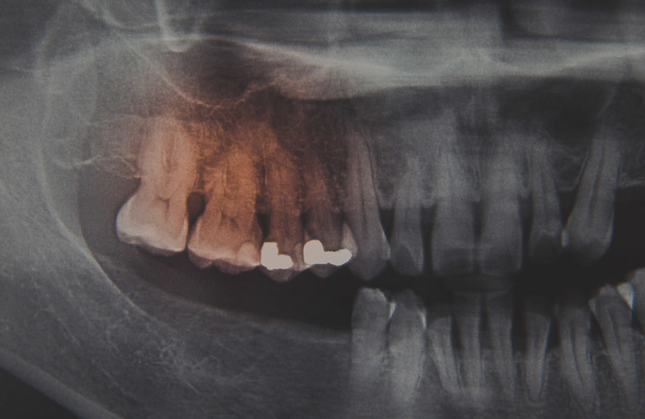 X-ray image of teeth showing possible gum disease, which could be causing bleeding and pain during brushing. • KOREA NEW N DENTAL CLINIC