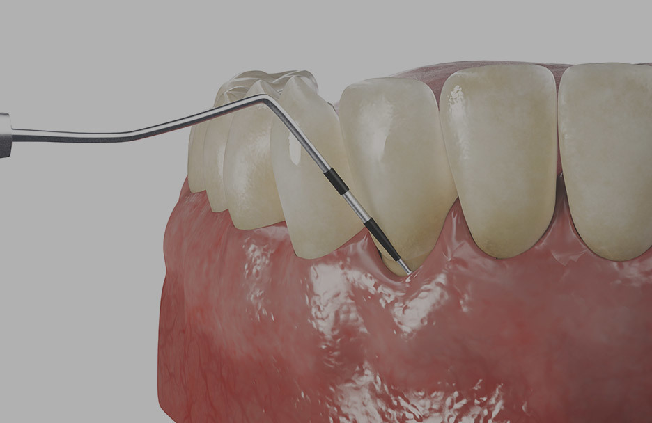 Close-up of professional gum treatment procedure using dental scaler to remove tartar from beneath gum line • KOREA NEW N DENTAL CLINIC