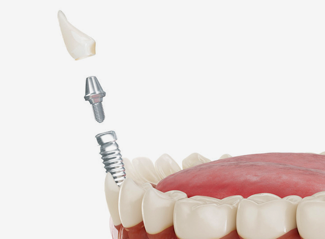 Close-up of dental implants being placed in a gum model. • KOREA NEW N DENTAL CLINIC