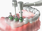 Dental navigation implants • KOREA NEW N DENTAL CLINIC