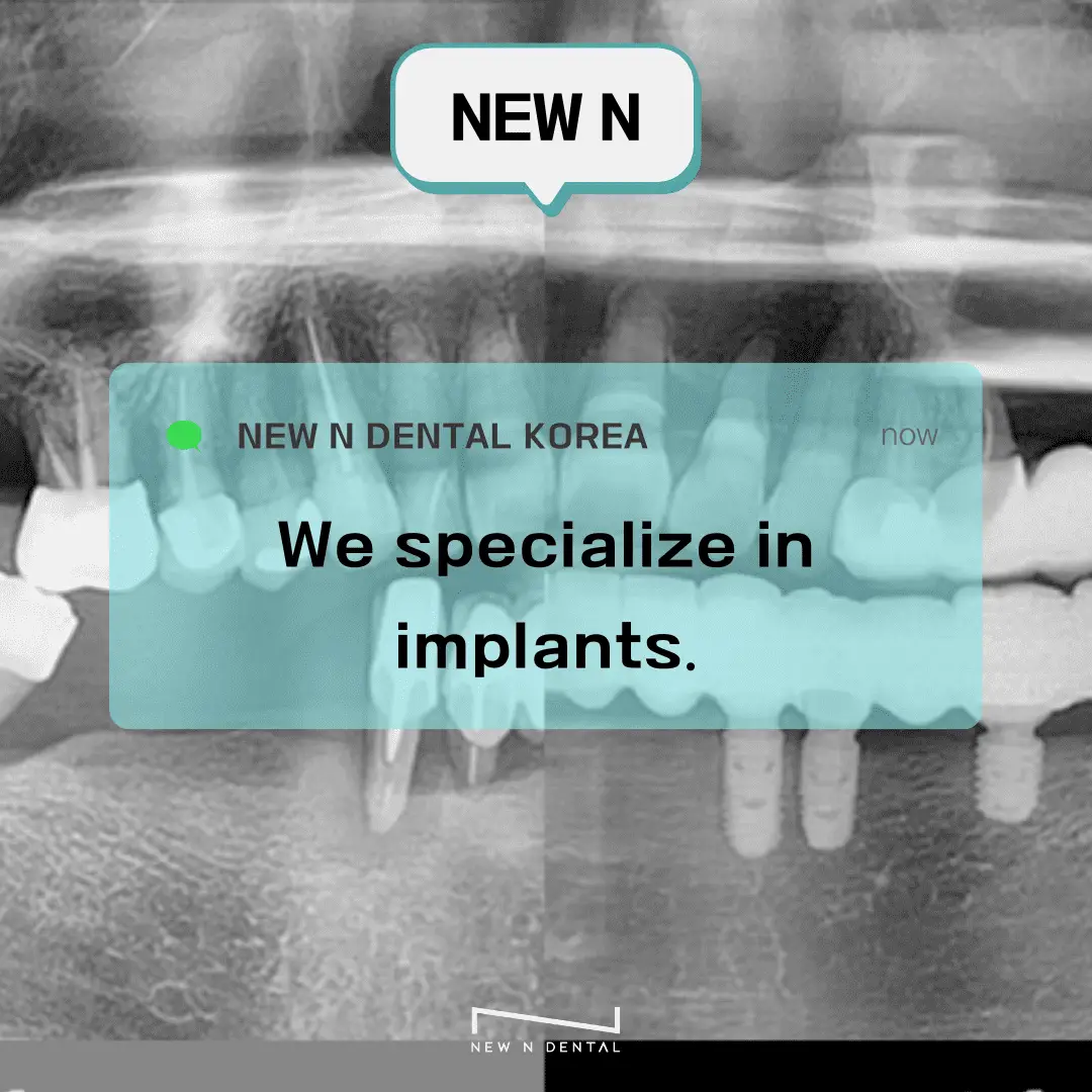 Before and after images of a dental procedure. The top half shows close-up photographs of teeth, with the left side labeled "Before" displaying damaged or missing teeth, and the right side labeled "After" showing restored and clean teeth. The bottom half shows X-ray images, with the left side labeled "Before" displaying the initial state of the jaw, and the right side labeled "After" showing dental implants in place.