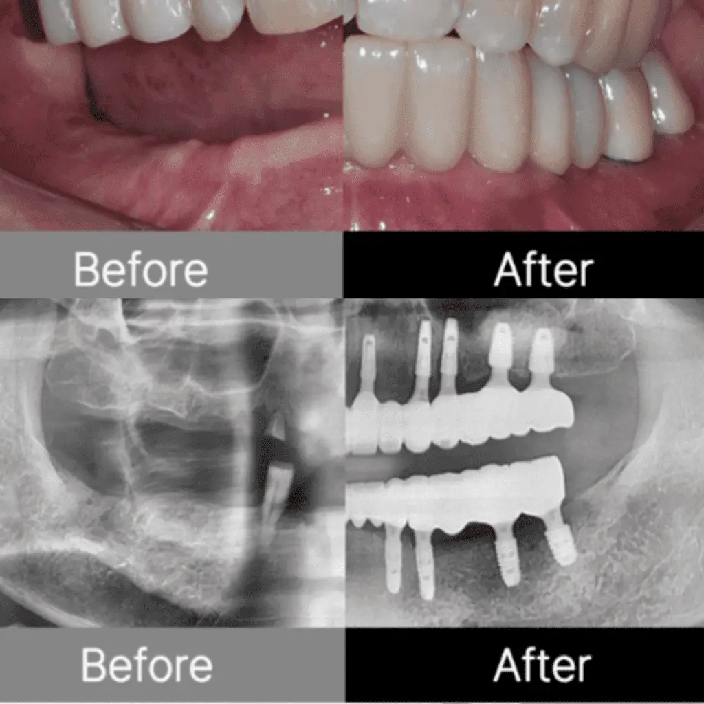 Before and after images of a dental procedure. The top half shows close-up photographs of teeth, with the left side labeled "Before" displaying damaged or missing teeth, and the right side labeled "After" showing restored and clean teeth. The bottom half shows X-ray images, with the left side labeled "Before" displaying the initial state of the jaw, and the right side labeled "After" showing dental implants in place.