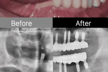 Before and after images of a dental procedure. The top half shows close-up photographs of teeth, with the left side labeled "Before" displaying damaged or missing teeth, and the right side labeled "After" showing restored and clean teeth. The bottom half shows X-ray images, with the left side labeled "Before" displaying the initial state of the jaw, and the right side labeled "After" showing dental implants in place.