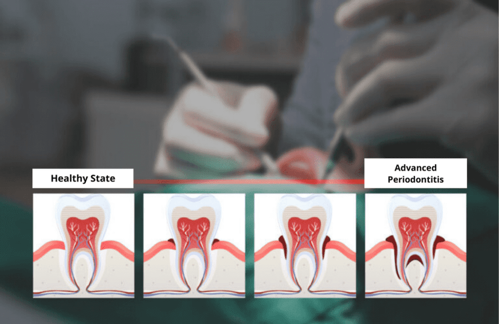 Stages of Periodontal Treatment - From Healthy Gums to Advanced Periodontitis • KOREA NEW N DENTAL CLINIC