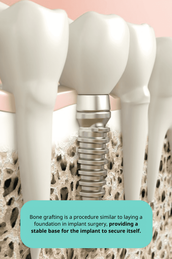 new n dental_bone grafting implant • Dental Clinic for English Speakers in Korea • KOREA NEW N DENTAL CLINIC