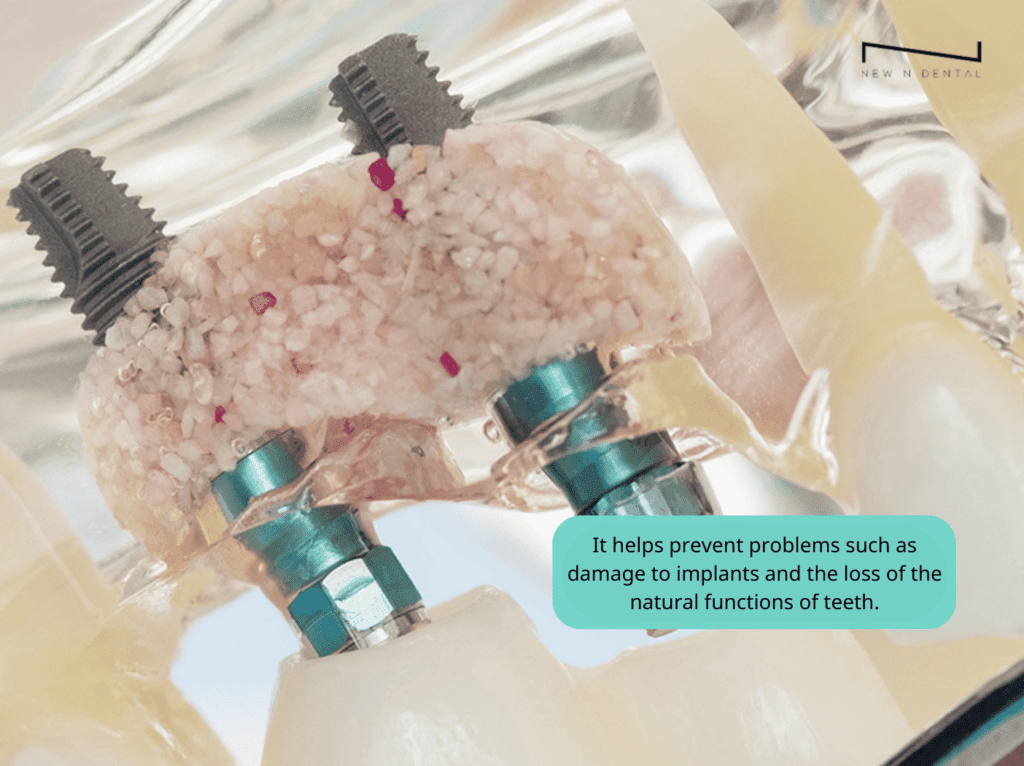 new n dental_bone grafting implant_2 • Dental Clinic for English Speakers in Korea • KOREA NEW N DENTAL CLINIC