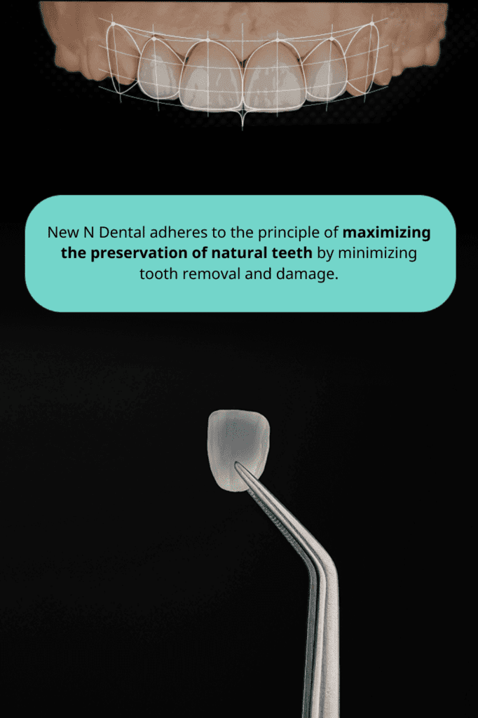 Laminate Veneer Treatment for Natural Tooth Preservation | New N Dental • Dental Clinic for English Speakers in Korea Porcelain laminate veneer held by dental instrument showcasing New N Dental's principle of maximizing natural tooth preservation and minimizing damage. • KOREA NEW N DENTAL CLINIC