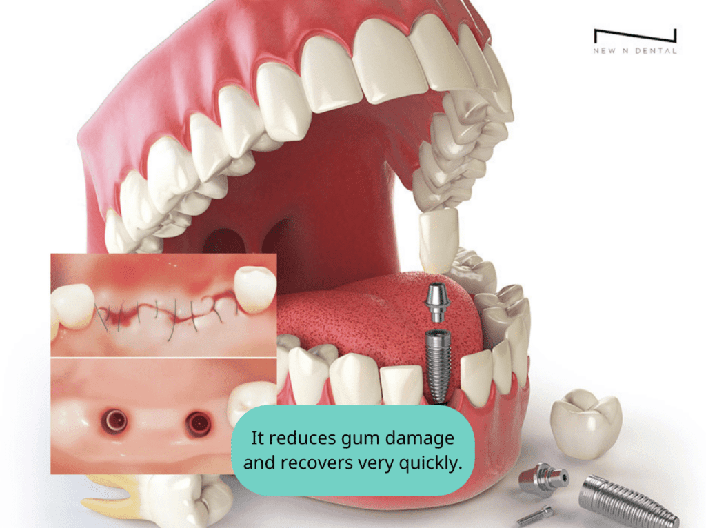 new n dental_total implant • Dental Clinic for English Speakers in Korea • KOREA NEW N DENTAL CLINIC
