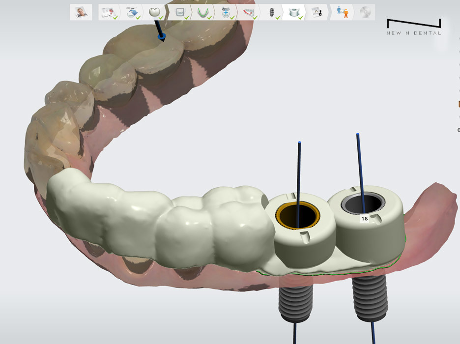 3D navigation implant model by New N Dental showcasing advanced dental implant technology with detailed surgical guide and dental prosthesis. • KOREA NEW N DENTAL CLINIC