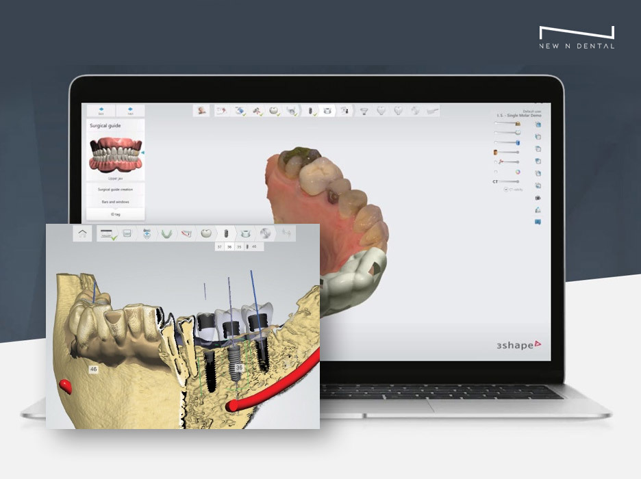 Dental implant surgery planning software displayed on a laptop showing detailed 3D images of teeth and jaw structure with surgical guides. • KOREA NEW N DENTAL CLINIC