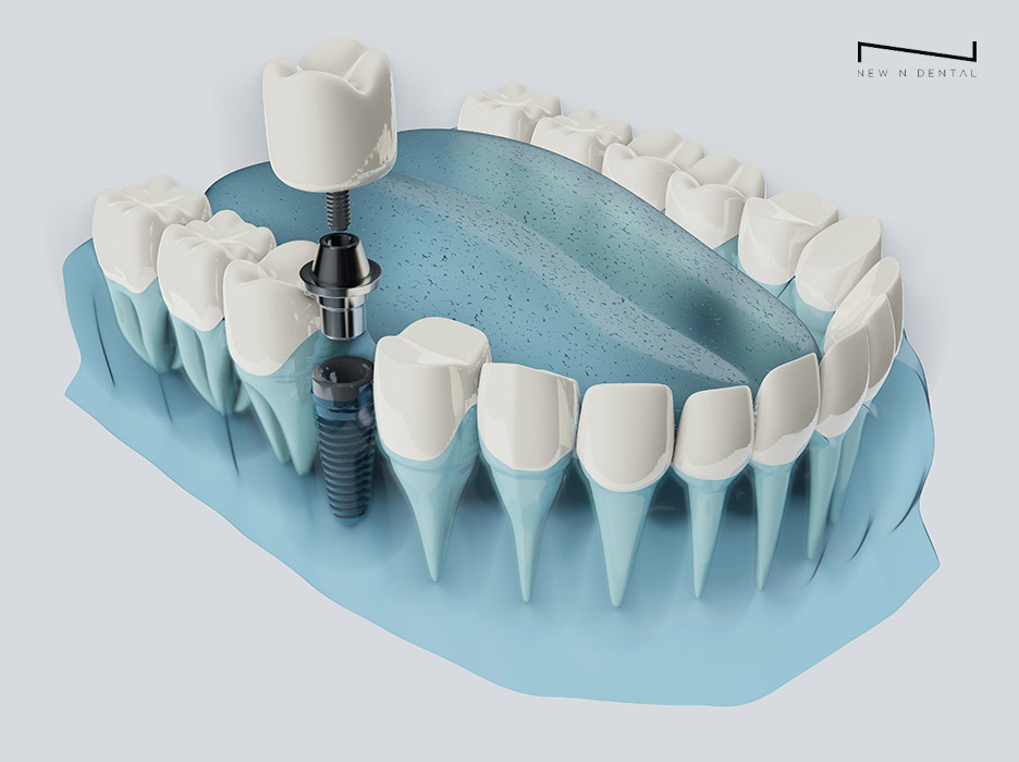 3D illustration of New N Dental one-day dental implant procedure • KOREA NEW N DENTAL CLINIC