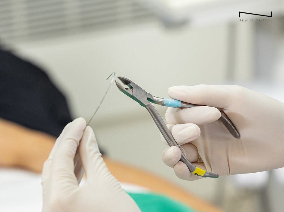 Close-up of gloved hands holding orthodontic pliers and wire for lingual and combi orthodontics. • KOREA NEW N DENTAL CLINIC