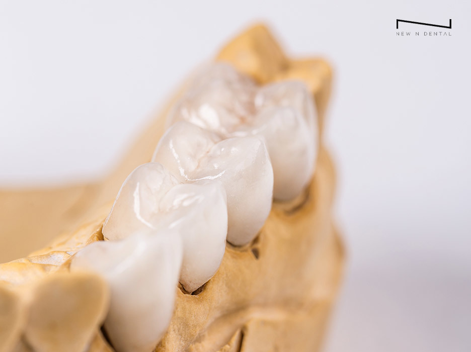 Detailed View of a Dental Crown Fitted on a Tooth Model by New N Dental • KOREA NEW N DENTAL CLINIC