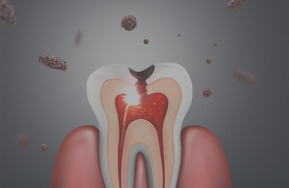 Cross-sectional illustration of a tooth with periodontal disease showing decay and infection deep within the gumline. • KOREA NEW N DENTAL CLINIC