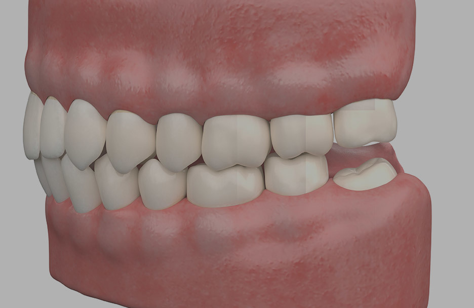 3D model of human teeth illustrating impacted wisdom teeth needing extraction for optimal oral health • KOREA NEW N DENTAL CLINIC