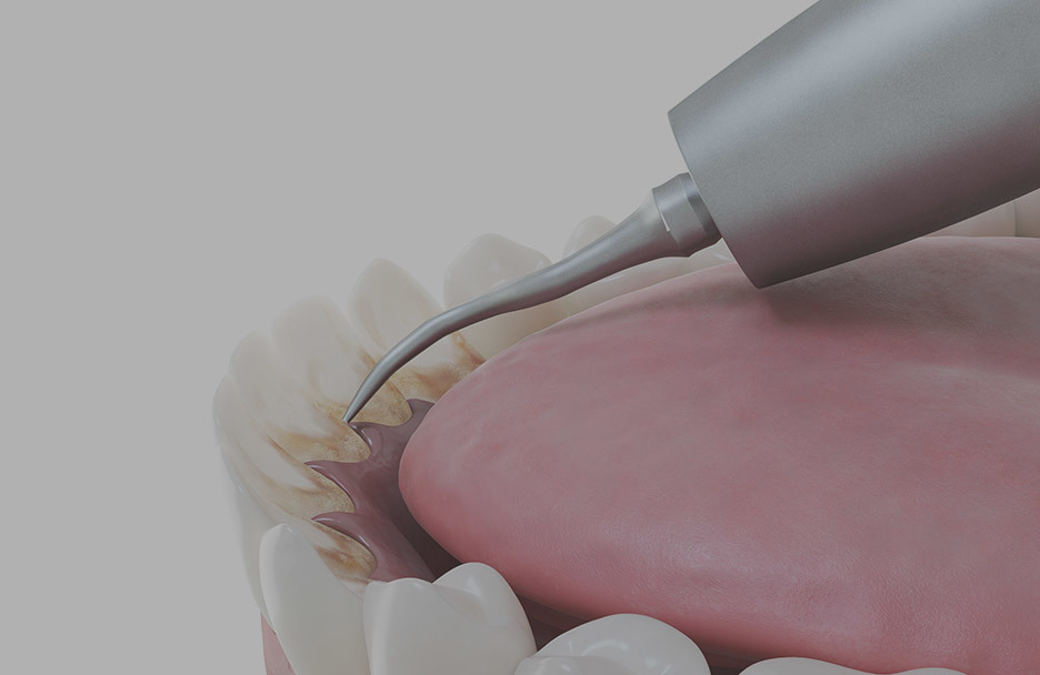 Dental scaling procedure to remove hard tartar from teeth and gums, preventing gingivitis • KOREA NEW N DENTAL CLINIC