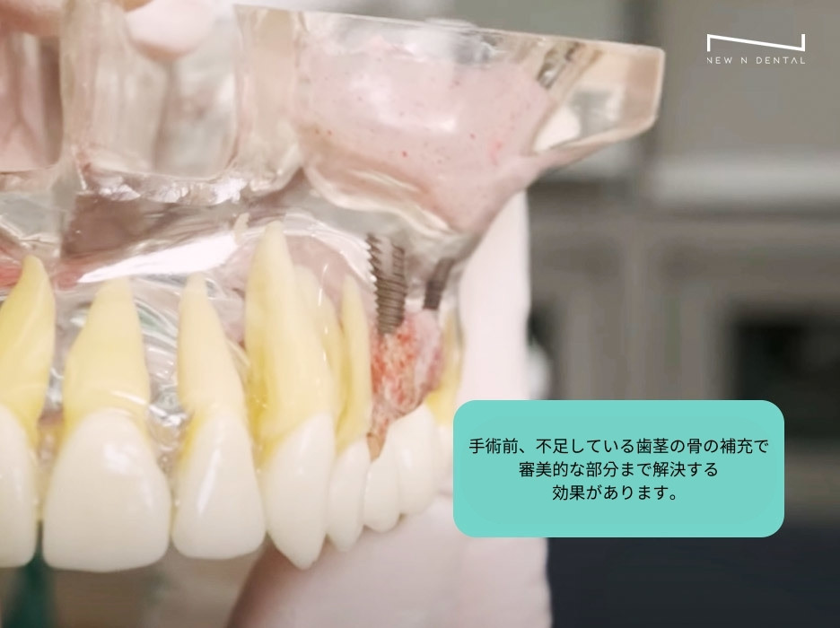 手術前、不足している歯茎の骨の補充で 審美的な部分まで解決する 効果があります。 • Dental Clinic for English Speakers in Korea • KOREA NEW N DENTAL CLINIC