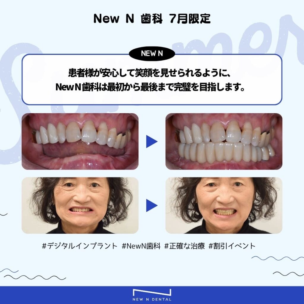 New N歯科でデジタルインプラントを受けた患者のビフォーアフター写真を示す広告。インプラントによって達成された変化を強調しています。