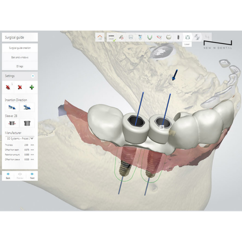 oneday implant