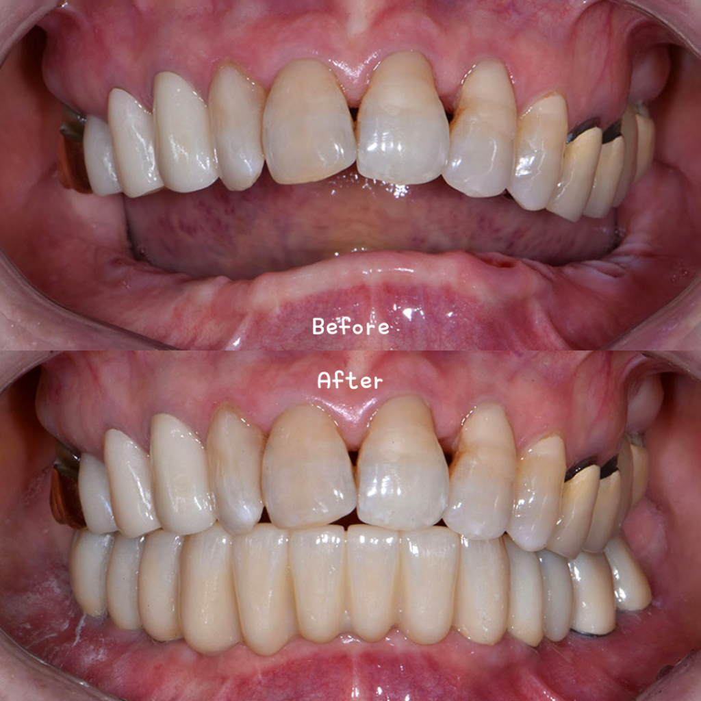 oneday implant before after