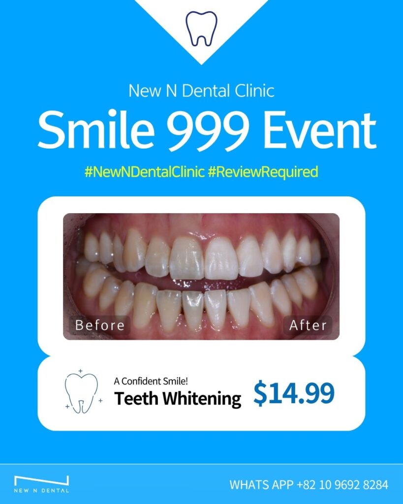 Before and after photo of Teeth Whitening at New N Dental Clinic Korea. Affordable $14.99 whitening treatment for foreigners. Korea dental care and laminates service available.