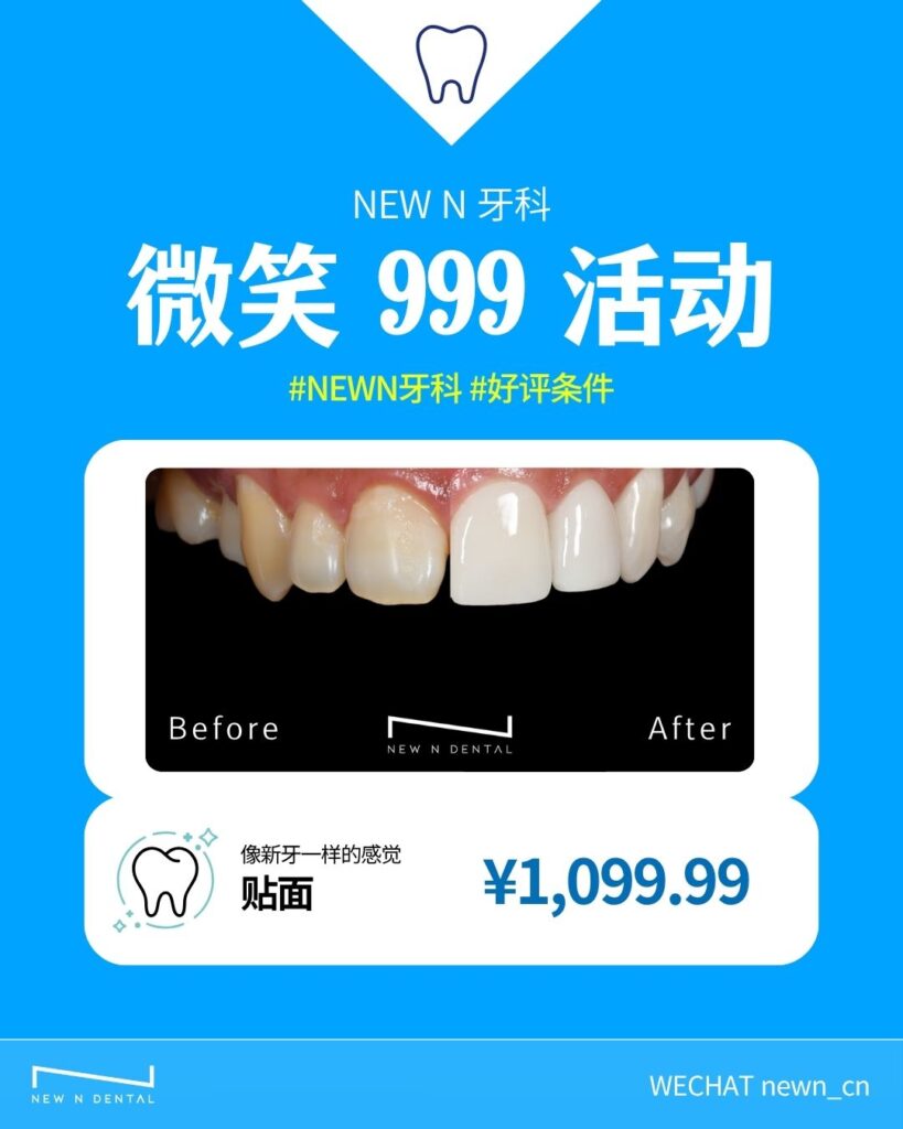 国NEW N牙科微笑999活动 - 韩国牙科贴面治疗前后对比效果，展示专业韩国牙齿美白贴面技术。韩国牙科诊所贴面治疗¥1,099.99，为中国患者提供高品质韩国牙科美白和贴面服务。韩国专业牙医贴面修复技术，让您拥有全新美丽笑容。