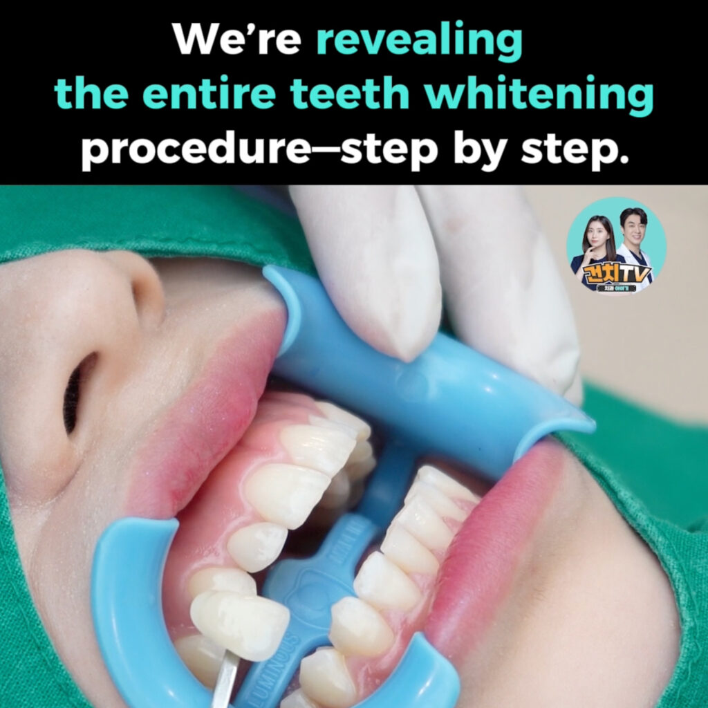 Were revealing the entire teeth whitening procedurestep by step • Dental Clinic for English Speakers in Korea • KOREA NEW N DENTAL CLINIC