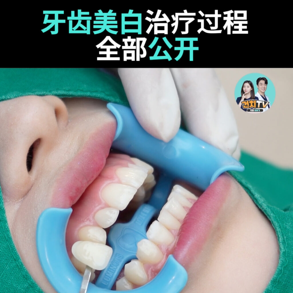 牙齿美白治疗过程 全部公开 • Dental Clinic for English Speakers in Korea • KOREA NEW N DENTAL CLINIC